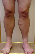 Deliveryman's aching varicose veins before correction